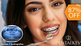 [Image: Colocación de Brackets Metálicos +  Evaluación + Limpieza + 2 Radiografíasm]