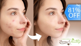 [Image: Terapia Clínica Anti Acné: Luz Pulsada + Alta Frecuencia + Exfoliación y Másm]