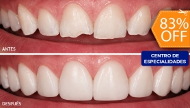 [Image: Reconstrucción Estética con Resina de 4 Dientes Frontales + Consulta + Revisión de Cordales + Limpieza y Másm]