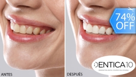 [Image: Blanqueamiento Dental Químico con Luz LED + Desmanchado con Profilaxis + Limpieza con Ultrasonido + Evaluaciónm]